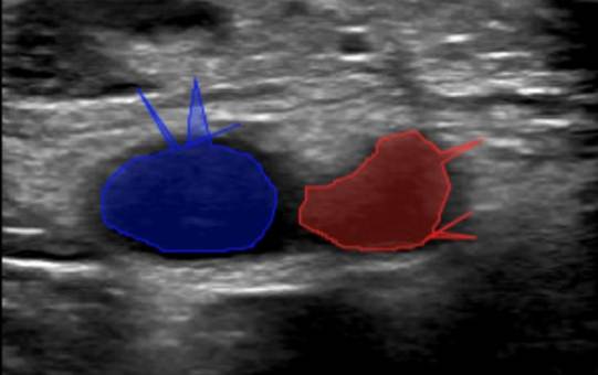 A ultrasound image of two blue and red ovals

AI-generated content may be incorrect.